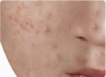 How to Get Rid of Dark Spots on the Face Naturally with AristoGlow